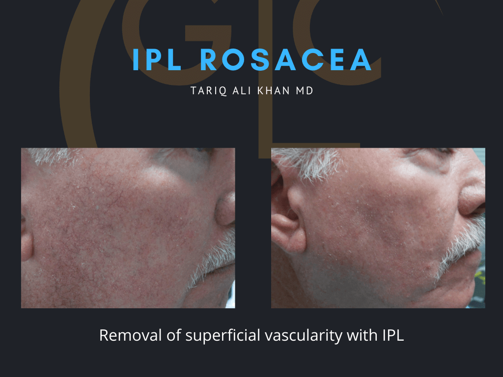 Gentle Care Laser Tustin Before and After picture - IPL Vascular